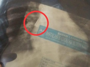 Gegara Sulap, Paku Bersarang 14 Hari di Tubuh Bocah Pangandaran