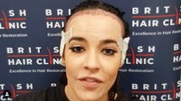 Kini ia melakukan transplantasi rambut. Dok. Instagram/stephaniedavis88
