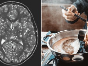Hii! 5 Kisah Mengerikan Cacing Bersarang di Tubuh karena Makan Daging Babi