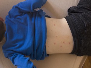 Kenali Gejala Campak, Obat, dan Pencegahannya