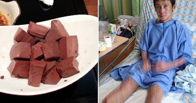 Karena Makanan, Orang-orang Ini Harus Diamputasi Kaki dan Tangannya