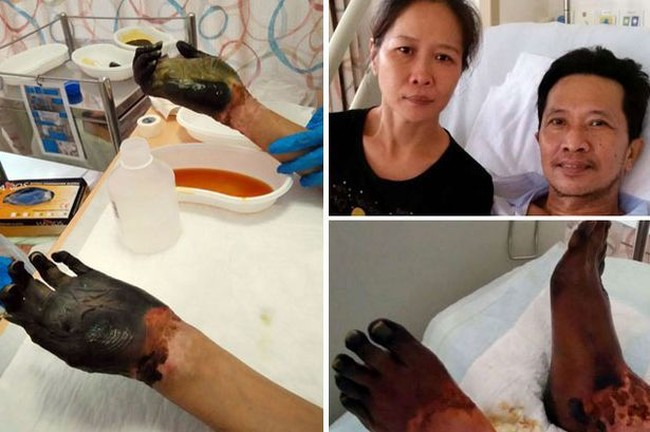 Karena Makanan, Orang-orang Ini Harus Diamputasi Kaki dan Tangannya