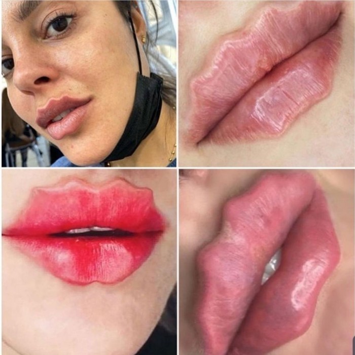 Tren terbaru, bibir keriting dengan filler. Foto: Dok. Reddit Tren terbaru, bibir keriting dengan filler. Foto: Dok. Reddit