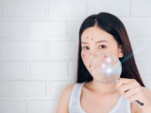 Ada Jerawat Membandel, Dibiarkan Saja atau Dipencet?