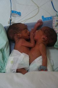 Lengket Perut dan Dada, Bayi Kembar Siam di Medan Dalam Keadaan Sehat