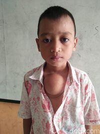 Kisah Bocah Suman yang Bersekolah dengan Benjolan Daging Sebesar Apel di Dada