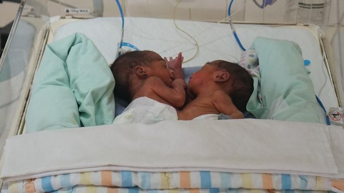 Bayi laki-laki kembar siam lahir di RSUPH Medan. (Foto: Budi Warsito/detikHealth) Bayi laki-laki kembar siam lahir di RSUPH Medan. (Foto: Budi Warsito/detikHealth)