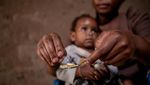Upaya Mengobati Anak-anak Positif HIV di Uganda