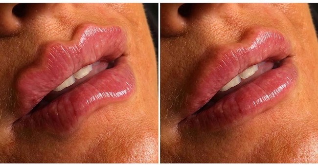 Beberapa wanita di Rusia bahkan sampai melakukan filler bibir untuk mendapatkan bentuk bibir keriting. Padahal filler bibir dengan bentuk tidak wajar seperti ini berbahaya dan banyak mendapat kecaman di forum Reddit serta dari sejumlah pakar kecantikan sendiri. Foto: Instagram aestheticsliverpool