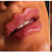 Beberapa wanita di Rusia bahkan sampai melakukan filler bibir untuk mendapatkan bentuk bibir keriting. Padahal filler bibir dengan bentuk tidak wajar seperti ini berbahaya dan banyak mendapat kecaman di forum Reddit serta dari sejumlah pakar kecantikan sendiri. Foto: Instagram aestheticsliverpool