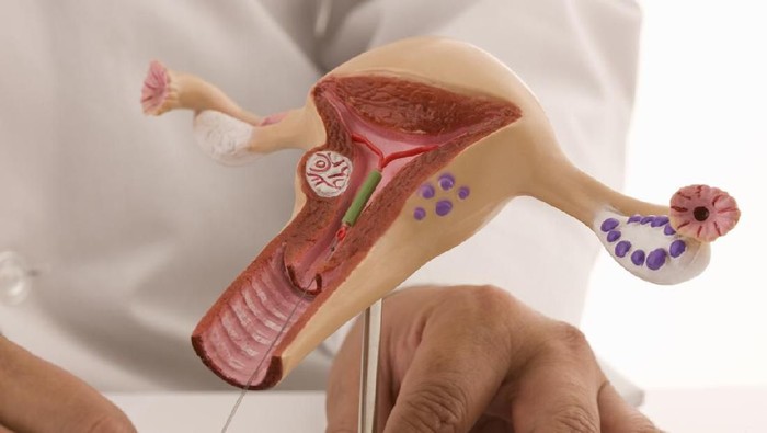 ilustrasi rahim Doctor inserting an intrauterine device as an example for contraceptive method.