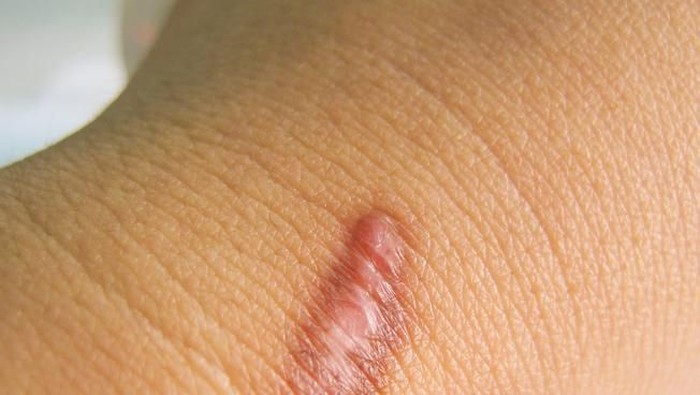 Pria di Cilegon Keluhkan Keloid di Leher usai Memancing, Kok Bisa?