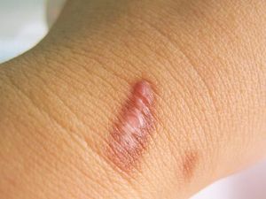 5 Pilihan Salep Keloid yang Ampuh, Mana yang Kamu Pilih?