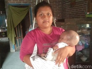 Kisah Balita Zahra, Penderita Hydrocephalus Sejak Lahir di Blitar