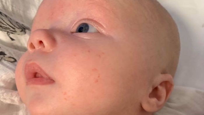 Bayi Delapan Minggu Digigit Ular di Keranjang Tempat Tidurnya