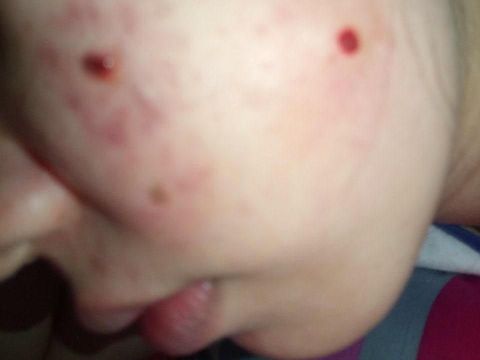 Youtuber Dihujat, Berbagi Tips Sesat Hilangkan Tahi Lalat Pakai Sabun Colek