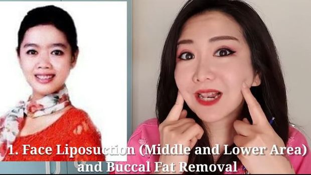 Ini Operasi Plastik yang Perlu Dilakukan Jika Ingin Secantik Siwi Sidi
