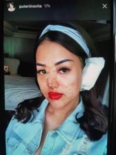 Heboh Pramugari Garuda Oplas, Ini Kisaran Harga Oplas Mata Sampai Hidung