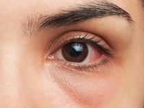 7 Obat Sakit Mata Alami, Kantong Teh hingga Air Mawar