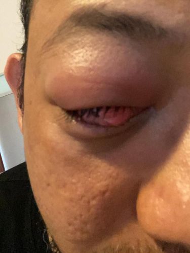 Mata Novel Baswedan Bengkak, Kembali Jalani Perawatan di Singapura