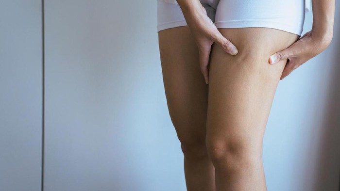 Woman with cellulitis on leg excess and overweight fatty of female