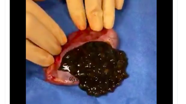 Disebut-sebut boba, tetapi para ahli lebih melihatnya seperti batu empedu.