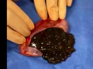 Terpopuler Sepekan: Heboh Video Butiran Boba di Kantung Empedu