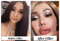 Filler, Lihat Before After Bibir Lucinta Luna yang Bengkak Bagai Kena Tawon