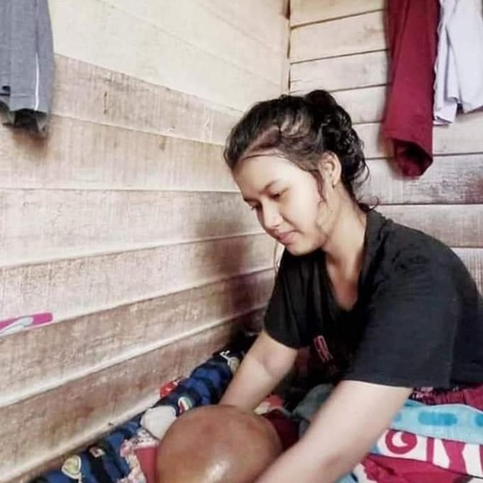 Siswi SMA Terkena Kanker Tulang di Kampar