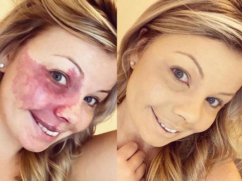 Kisah Wanita Punya Tanda Lahir Besar di Wajah, Berjuang untuk Percaya Diri