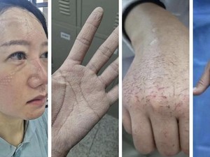Potret Penuh Luka Para Perawat di China yang Tangani Virus Corona