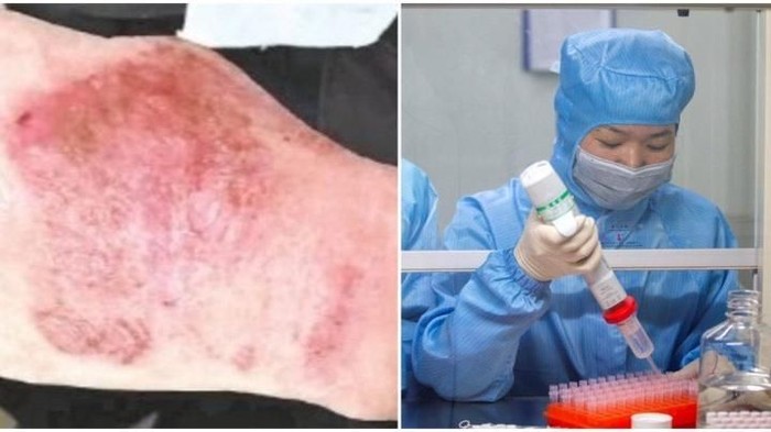 tangan bengkak karena 12 jam bekerja di lab virus corona tangan bengkak karena 12 jam bekerja di lab virus corona