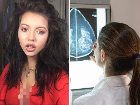 Kisah Wanita yang Punya 4 Payudara, Stres Hingga Menanggung Malu 07.30