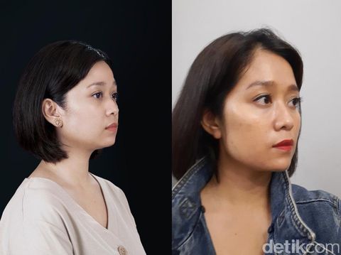 Pengalaman Pertama Mencoba Botox dan Filler di Klinik Kecantikan 