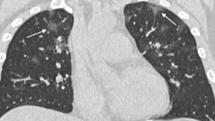Penampakan paru-paru seorang pria dengan riwayat pergi ke Wuhan. (Radiological Society of North America) Penampakan paru-paru seorang pria dengan riwayat pergi ke Wuhan. (Radiological Society of North America)