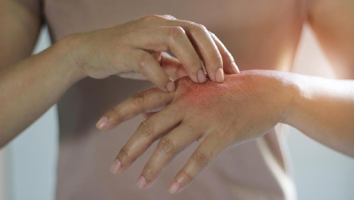 Healthcare and medical concept. Female scratching the itch on her hand, cause of itching from skin diseases, dry skin, allergy, chemical, allergic to detergent or dishwashing liquid and dermatitis, insect bites, burned, drug. Health problem.