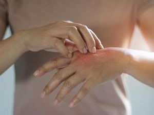 e-Life : Epidermolisis Bullosa, Kelainan Kulit Langka Pada Manusia
