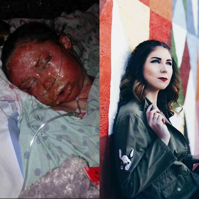 Delaney mengalami luka bakar tingkat tiga. Seluruh wajah dan beberapa area tubunya penuh dengan luka bakar, bahkan Delaney tidak memiliki kulit wajah lagi. Untuk memulihkan kondisi wajahnya yang sudah penuh dengan luka bakar, ia membutuhkan 25 kali operasi, termasuk terapi laser untuk mengurangi. Foto: dok. Instagram