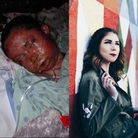 Delaney mengalami luka bakar tingkat tiga. Seluruh wajah dan beberapa area tubunya penuh dengan luka bakar, bahkan Delaney tidak memiliki kulit wajah lagi. Untuk memulihkan kondisi wajahnya yang sudah penuh dengan luka bakar, ia membutuhkan 25 kali operasi, termasuk terapi laser untuk mengurangi. Foto: dok. Instagram