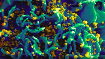 Sel T H9 yang terinfeksi HIV. Mikrograf dari partikel HIV yang menginfeksi sel T H9 manusia, berwarna biru, turqoise, dan kuning. Foto: NIAID via Weather.com