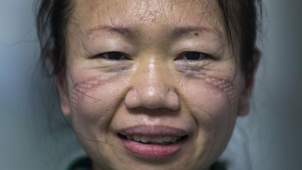 Wajah Seorang Perawat di Wuhan Terluka Imbas Pakai Masker In this Sunday, Feb. 16, 2020, photo, scar marks made from wearing protective mask leaves on a face of a nurse at Jinyintan Hospital designated for new coronavirus infected patients, in Wuhan in central China's Hubei province. China reported thousands new virus cases and more deaths in its update Tuesday, Feb. 18 on a disease outbreak that has caused milder illness in most people, an assessment that promoted guarded optimism from global health authorities. (Chinatopix via AP)