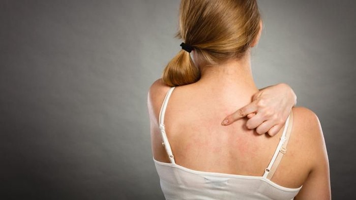 Jerawat di punggung Health problem, skin diseases. Young woman showing her itchy back with allergy rash urticaria symptoms