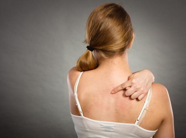 Health problem, skin diseases. Young woman showing her itchy back with allergy rash urticaria symptoms