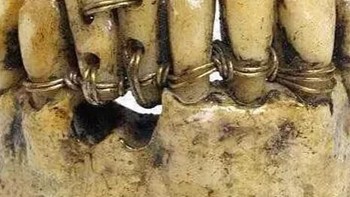 Prostesis gigi yang berasal dari zaman Romawi kuno. Foto: Pinterest via Gent Side