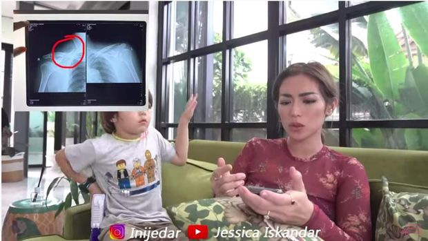 Jadi Korban Tabrak Lari, 5 Tulang Rusuk Ayah Jessica Iskandar Patah