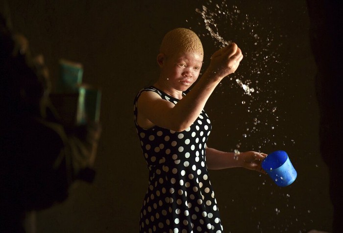 Orang-orang Albino di Malawi Di beberapa negara Afrika orang albino kerap dianggap punya kekuatan magis. Kepercayaan itu membuat orang albino diculik dan diburu demi diambil bagian tubuhnya.