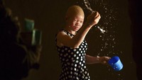 Catherine merupakan salah seorang warga Malawi yang lahir dengan kondisi albinisme atau albino. Albino merupakan kelainan genetik yang membuat penderitanya kekurangan pigmen pada kulitnya.