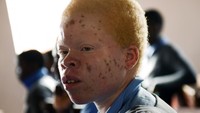 Pilihan memasukan anak-anak albino tersebut ke sekolah asrama pun dinilai sebagai salah satu cara untuk membuat mereka aman karena pengawasan dan penjagaan sekolah yang lebih baik. Anak-anak albino itu pun bisa mendapatkan pendidikan yang baik guna meraih cita-cita mereka di masa yang akan datang.