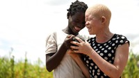 Catherine Amidu, seorang gadis albino, tengah asyik bermain dengan temannya di area sekitar rumahnya yang berada di kawasan Machinga, Malawi, Afrika.