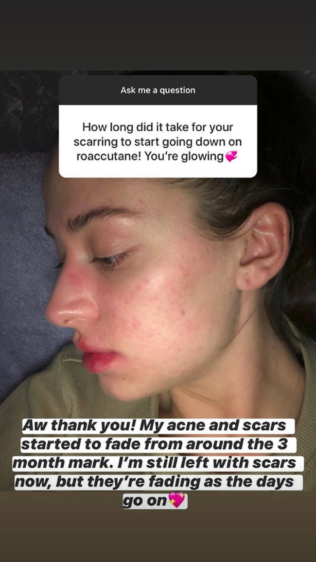 Dari tidak bisa menyentuh wajah tanpa terasa sakit hingga tidak ingin meninggalkan rumah karena takut aku kelihatan jelek, jerawatku telah mengambil alih hidupku. Setelah mencoba semuanya di pasar dan menerima komentar jahat mengenai keadaan kulitku, aku akhirnya memberanikan diri dan mulai minum Roaccutane, Foto: Instagram @ashleighwild_